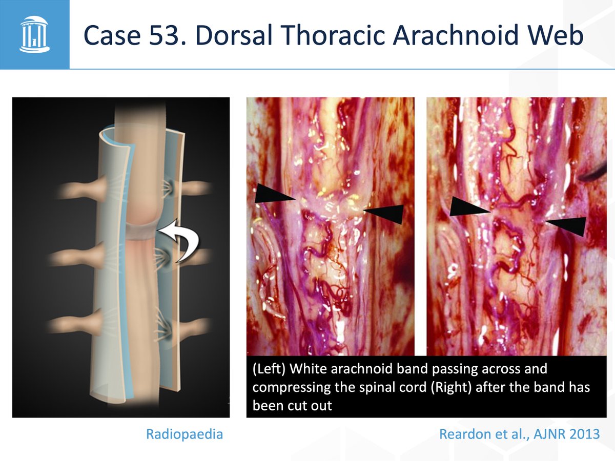 @UNCRadiology @UNCRadRes @ShengChe Answer: Dorsal thoracic arachnoid web
