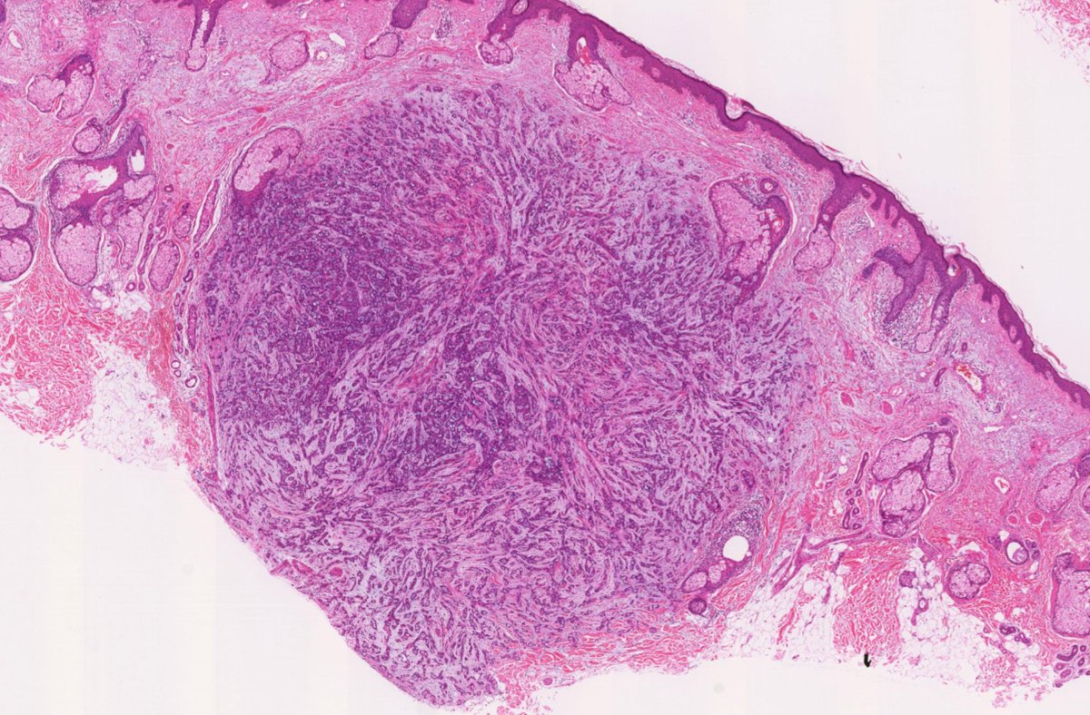 HENRYY_MD's tweet photo. Happy Sunday! Sharing a  case  you know you will agree with me: what a Beauty!-cheek lesion. 52 XY
#dermpath #PathTwitter #histologybeauty 
@et565 @david_terrano @PIorfino @TristanRutland7 @MarcelaSaebL @mccalmo @gonzadetoro @ArjunRamaiya1 @atman_ci @pepeheffernan @DiegoMoralesN https://t.co/5WUAeKEe3d