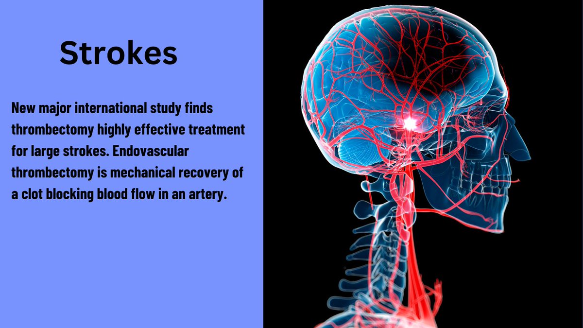 NeuroIRdoc's tweet image. 🧠A large international clinical study finds that patients with large strokes had a dramatically better recovery after #endovascular thrombectomy plus medical management than patients receiving only standard medical management
 
👉news.uhhospitals.org/news-releases/…

#Neurology #thrombectomy