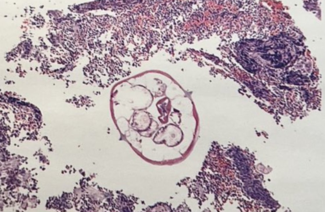 RawiaMo57385655's tweet photo. What is this in the lumen of the appendix ?
#PathTwitter #GITpath https://t.co/CpRMrnz1wN