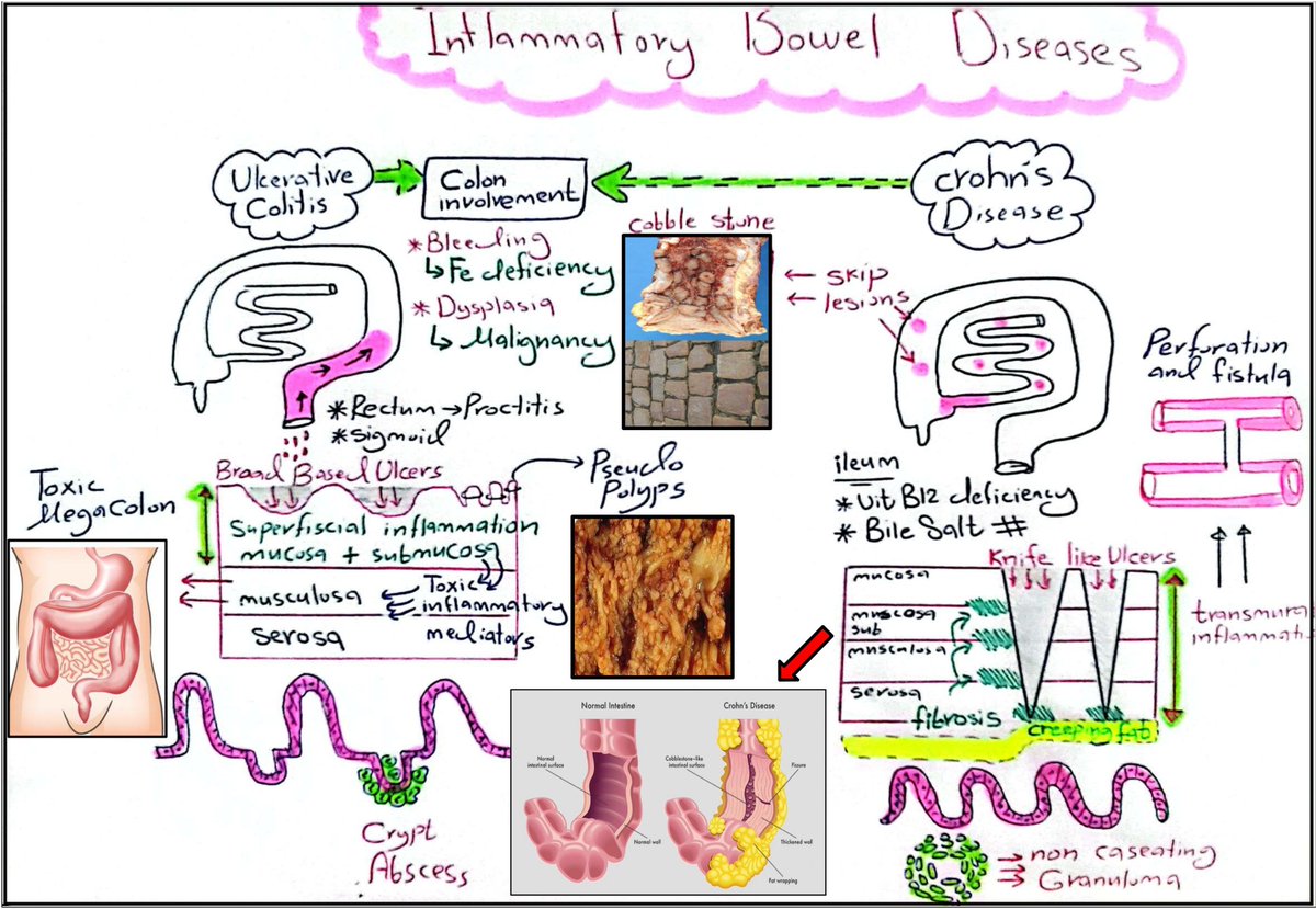 inflammatory Bowel Disease
#Ulcerative_Colitis
#Crohns_Disease

Done by me 😁🙌🏻🤍