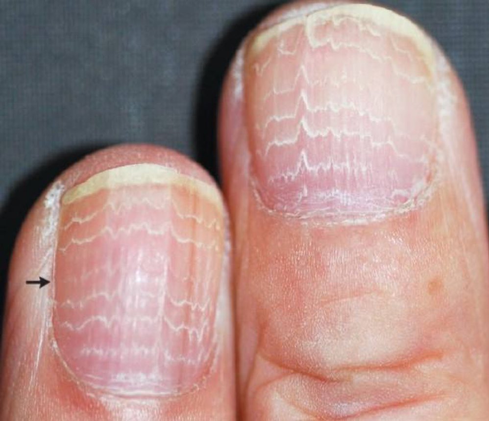 Nails of a patient with gastric cancer. What’s going on here?