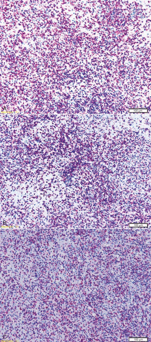 pathobotology's tweet photo. #Pathology #quiz!
1. What tissue is this (#hemepath)?
2. What is in your differential?
3. What is your diagnosis? #WiyD
Case details will be posted as a reply soon! https://t.co/6wlPuw4Ibc