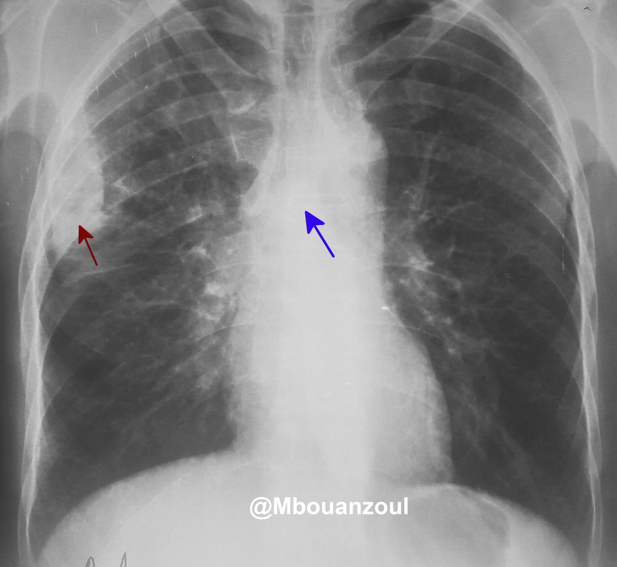 MBouanzoul's tweet image. Hi!
Which is the primary tumor, the blue or the red one? 
Squamous cell carcinoma of the lung in a 46-year-old man with a heavy smoking habit. 
Suggestions or criticisms welcome!
#pulmtwitter #lungcancer #Radtwitter #chestrad  #radres