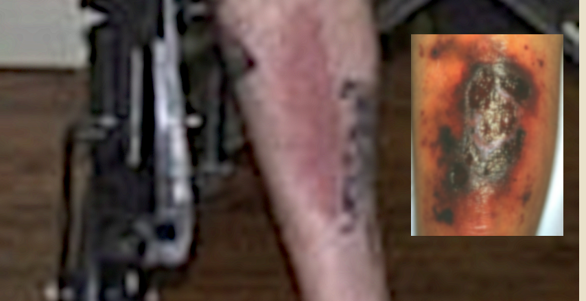 R0b1999's tweet photo. @AlexSprackland AlexSprackland wrote "psoriasis".

Psoriasis is an autoimmune disease, as is dermatomyositis. Having one autoimmune disease increases your odds of developing another one.

Your rashes could be diagnostic: the black areas look like vasculitis ... https://t.co/EkL1HQa93y https://t.co/V4CkSJ9PWA