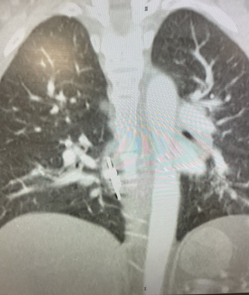 #GITwitter 40F with GERD & language barrier pw burning with PO but tolerating purée, no nausea or emesis. Exam benign. ED scans patient and call you for esophageal foreign body. Diagnosis ⁉️ #MedTwitter