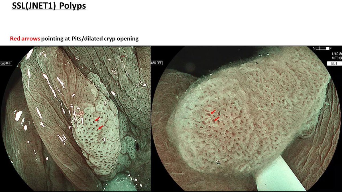 #GiTwitter, understanding the basic adenoma is 🔑 before assessing complex polyps.  💡BLI/NBI highlights microsurface/microvasculature, NOT the pit. For precise pit-pattern exam, indigo/crystal violet is needed (exception: type II-O pit in SSLs seen well w/ BLI/acetic acid)