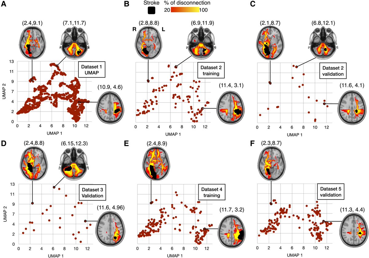 Dr_Alex_Crimi's tweet image. #brain stuff: &quot;Latent disconnectome prediction of long-term cognitive-behavioural symptoms in #stroke &quot; by L. Talozzi @StephForkel @MauCorbetta .@MichelTdS  and others academic.oup.com/brain/article/… a #UMAP of stroke lesion