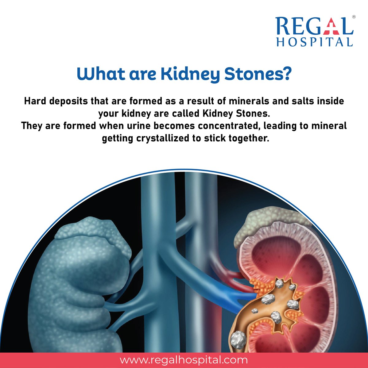 RegalHospital's tweet photo. Kidney Stones can be considered as a rising threat to the people as inadequate health habits can lead to serious problems. With proper lifestyle changes, Kidney Stones can be avoided.

Follow for more facts on Kidney Stones

#KidneyStones #KidneyHealth #PreventKidneyStones https://t.co/noNjnKZ0tk