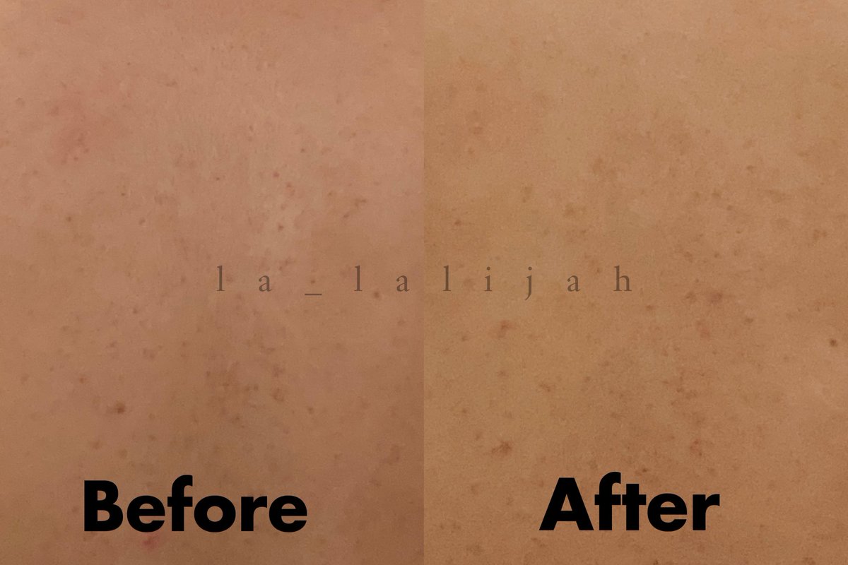 la_lalijah's tweet photo. Mandi pakai sabun aja ternyata kurang untuk punggung aku😭 Faktor keringetan kadang bikin ada jerawat atau biang keringet yg bahkan bisa bikin gatel dan jadi luka krn digaruk.

Aku mau #racuninbodycare dari NPURE ini!🫶 https://t.co/w7DcGuBjcB
