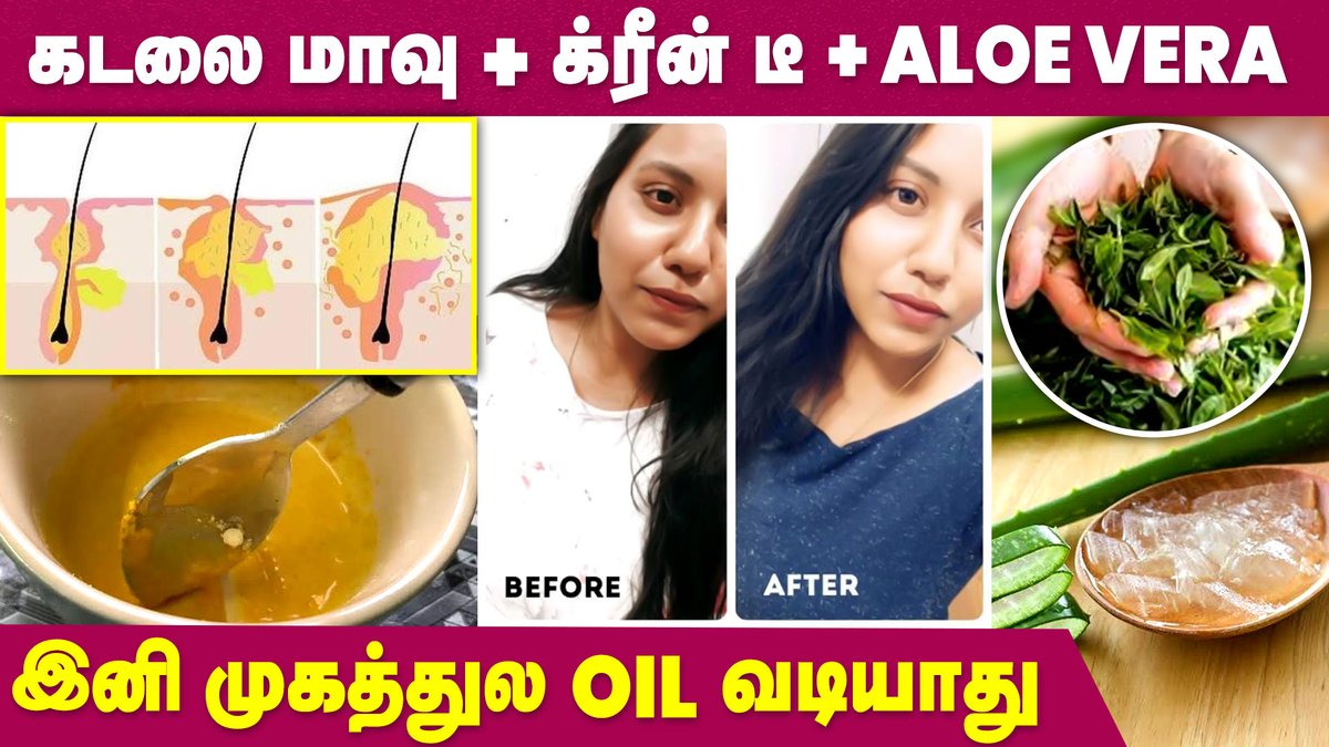 IbcMangai's tweet image. DIY Pack for Oily Face | Oily Face home remedy

Watch&amp;gt;&amp;gt; youtu.be/fAW2oZGMErk

#diypack #oilyface #beautytips #ibcmangai