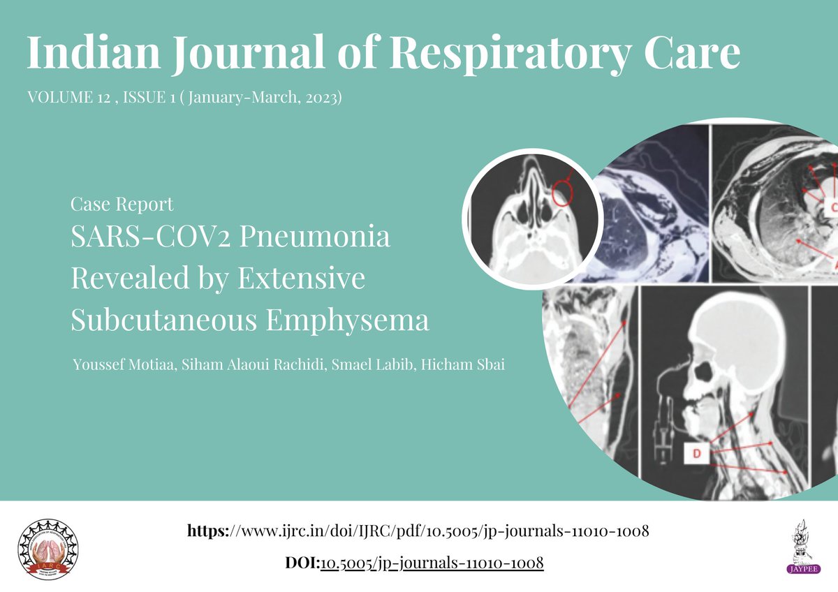 Fascinating case report! 'SARS-COV2 #Pneumonia Revealed by Extensive #Subcutaneous #Emphysema' uncovers a unique diagnostic pathway.🩺💡 Dive into this intriguing study shedding light on #COVID19 complications. Read more: ijrc.in/doi/IJRC/pdf/1… #RespiratoryCare @IARCToday