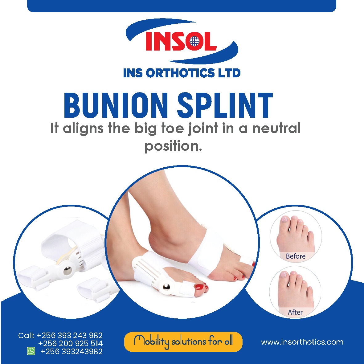 The bunion splint consists of a cushioned pad that sits over the bunion, along with straps that gently pull the big toe back into its proper position providing support and maintaining correct alignment.