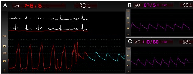 Reviews in Cardiovascular Medicine (@rcmjournal) on Twitter photo #RCM - Vol. 24 No. 5
🪘Review
Acute Left Ventricular Ballooning: Tools to Differentiate Hypertrophic Cardiomyopathy with Outflow Obstruction from Neurohumoral Takotsubo Syndrome
📒<a href="/ArushiSinghMD/">Arushi Singh</a>, <a href="/LouaiRazzouk/">Louai Razzouk, MD MPH</a>, <a href="/danmassera/">Daniele Massera</a>, Mark V. Sherrid
#HCM #TTS
📢
imrpress.com/journal/RCM/24… #RCM - Vol. 24 No. 5
🪘Review
Acute Left Ventricular Ballooning: Tools to Differentiate Hypertrophic Cardiomyopathy with Outflow Obstruction from Neurohumoral Takotsubo Syndrome
📒<a href="/ArushiSinghMD/">Arushi Singh</a>, <a href="/LouaiRazzouk/">Louai Razzouk, MD MPH</a>, <a href="/danmassera/">Daniele Massera</a>, Mark V. Sherrid
#HCM #TTS
📢
imrpress.com/journal/RCM/24…
