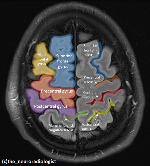 chrost_hugo's tweet photo. An excellent presentation of the neuroanatomy of the top view of the brain.

Source: @theneuroradguy

#neuroscience https://t.co/be6VRz9ZPS