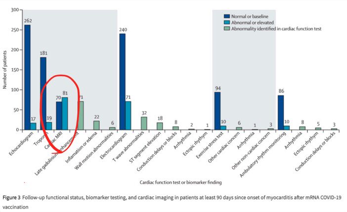 At 3-6 months after myocarditis due to the COVID-19 vaccine in children and young adults, heart abnormalities remain in more than 50%.

The long-term consequences of these abnormalities are currently unknown.

thelancet.com/journals/lanch…