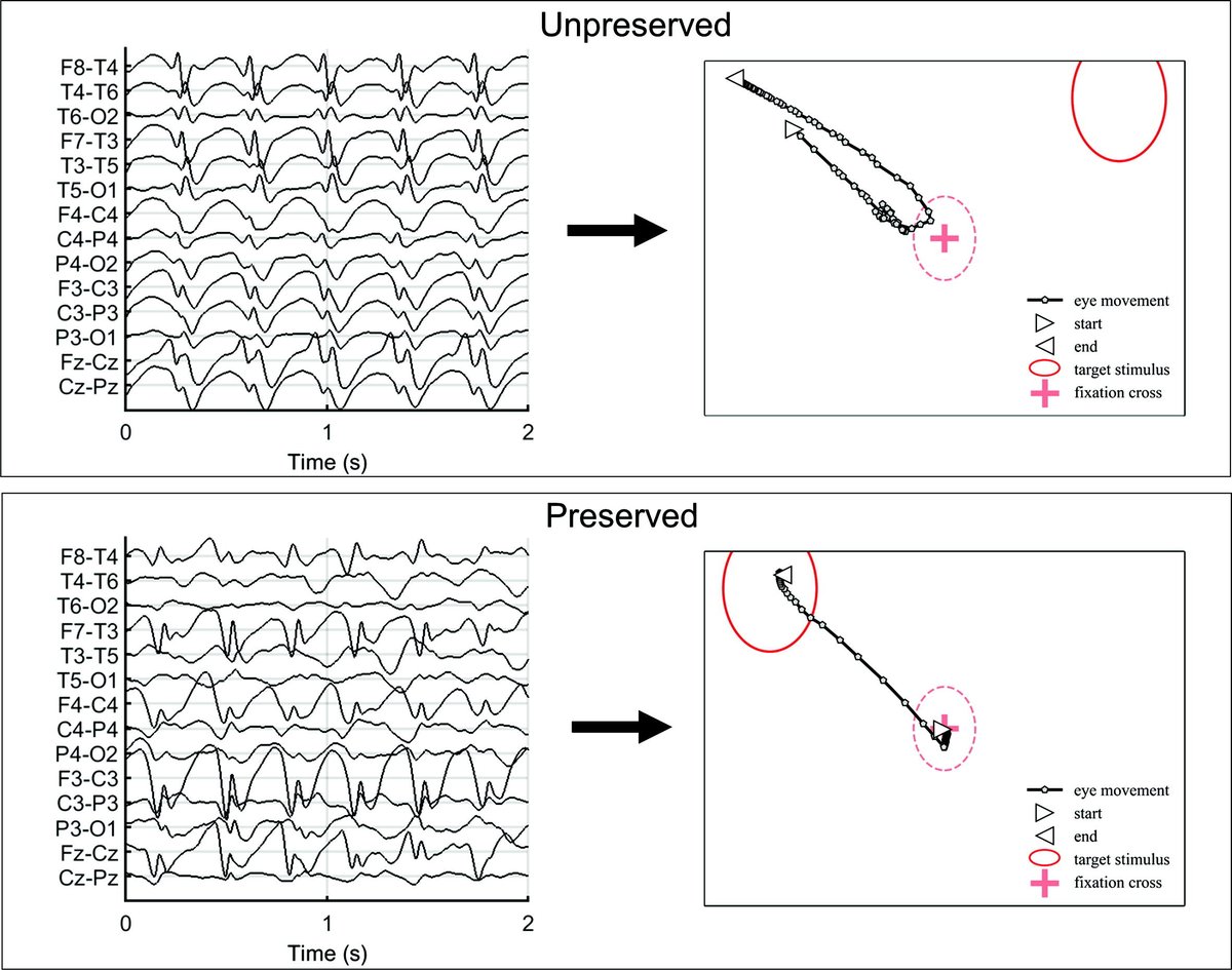 [Epilepsy] Barone et al.: 'Absence seizures affect visual attention and eye movements variably. Deficits in visual attention during absences are associated with differences in EEG features and network activation.'

doi.org/10.1016/j.clin…

#EyeTracking #AbsenceEpilepsy