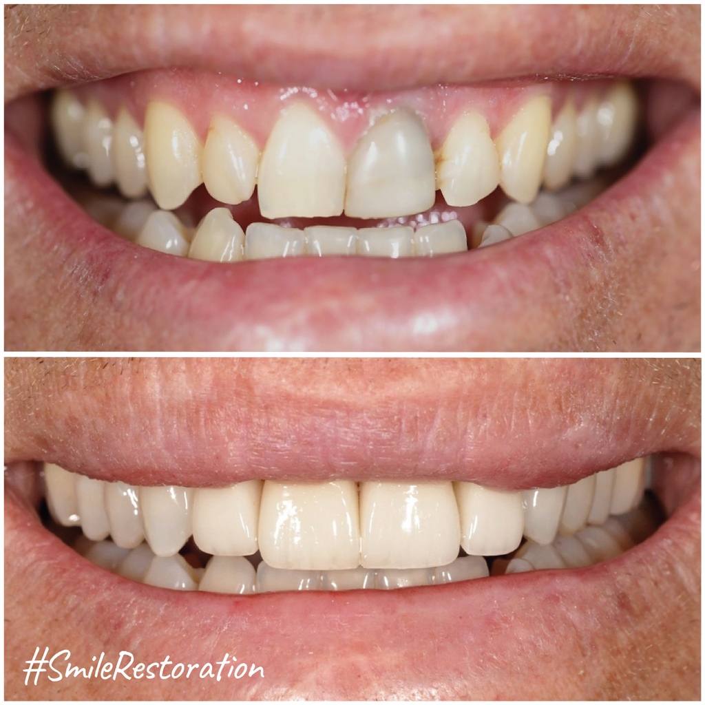 MicrisDental's tweet image. An accident left this patient with a discoloured #fronttooth &amp;amp; other dental issues.

But, with the help of Dr. Marwan Al Obeidi's dental expertise, the patient got his smile restored using #veneers &amp;amp; #crowns.

Now the patient has regained his #naturasmile &amp;amp; a perfect #oralhealth.
