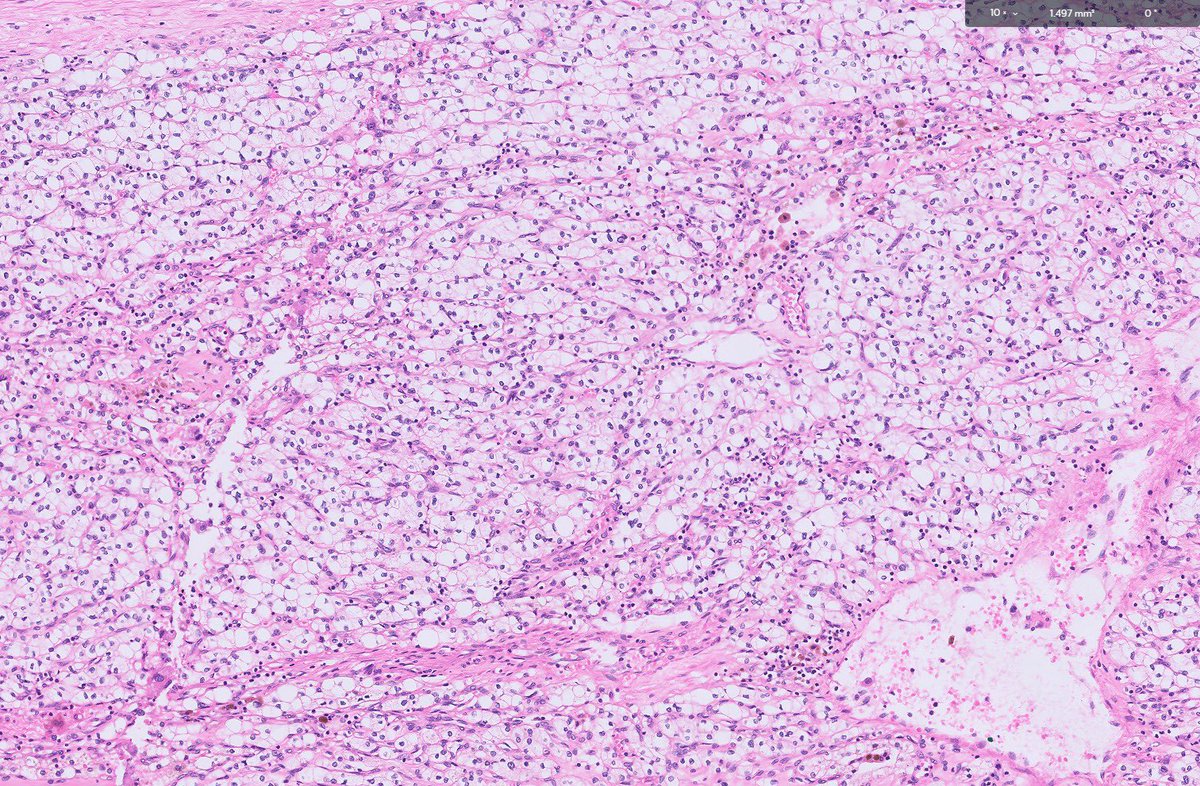 RawiaMo57385655's tweet photo. Kidney tumor 

#PathTwitter #pathologyfamily #pathology #GUpath https://t.co/M2z21OW6v1
