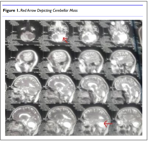 Pre-Induction Scalp Block in a Patient of von Hippel-Lindau Disease: Promising Use in High-Risk... by Uma Hariharan, MBBS, DNB [ISSN 2689-1255] 📖Read the full article here: bit.ly/3oAOLn8 ✍Submit your manuscript: bit.ly/45kjeX6 . . #openventio #Neurosurgery