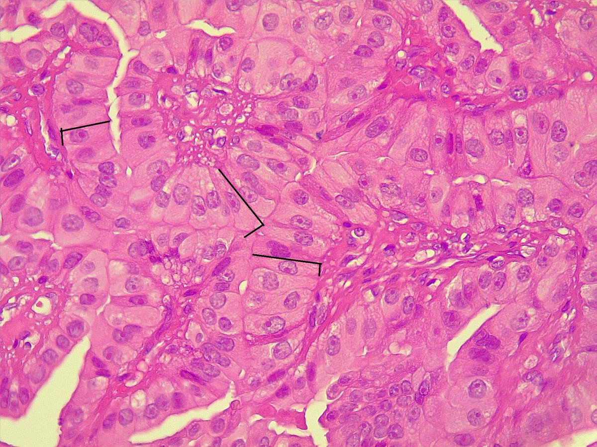 Tall cell subtype of papillary thyroidcarcinoma (not any more variant) means really tall cells, not above average, 3 times taller than width or more than that.. #PathTwitter