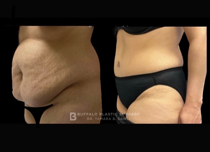 Tummy Tuck transformation ⁠
📸Shared with patient permission⁠
📞 Phone: 716.821.2935⁠
🖥️ Website: buffaloplasticsurgery.com⁠
📍 Location: Buffalo, New York⁠
.⁠
#mommymakeover #breastaugmentation #buffalony #drdawli #plasticsurgerybeforeandafter #tummytuck #bellybutton