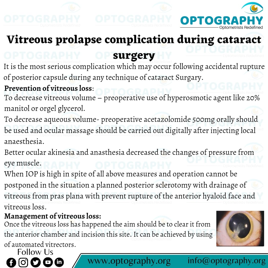 Cataract surgery is a procedure to remove the lens of your eye and, in most cases, replace it with an artificial lens. Normally, the lens of your eye is clear. A cataract causes the lens to become cloudy, which eventually affects your vision.

#eyecare #optography