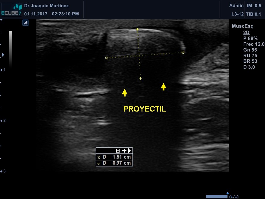 Proyectil de arma de fuego en plano subcutáneo por ultrasonido.
<a href="/NephroP/">NephroPOCUS</a> <a href="/anaseguragrau/">AnaSegura</a> <a href="/yaletung/">Yale Tung-Chen</a> <a href="/SonoSamMD/">Samuel García Rubio</a> <a href="/y_interna/">Medicina Interna. Lo miro y mañana te digo.</a> <a href="/DraMariaSerna/">MARIA SERNA GANDIA</a> <a href="/drPowerDoppler/">DrDopplerPoder</a> <a href="/trigeminy_henry/">Stax_Baseball_Cards</a> <a href="/zbriote/">José António Briote Mariz</a> <a href="/PierpaDiNick/">Pierpaolo Di Nicolò</a> <a href="/ABCDEcografia/">ABCDEcografía</a> <a href="/manuelesuarez65/">Manuel E. Suárez</a> <a href="/jpalacinp/">Jose Maria Palacin</a> <a href="/DiazgomezA/">Alfredo Díaz Gómez</a> <a href="/mberchid/">M. Solimán Berchíd Debdi</a> <a href="/EcosemfyC/">EcosemFYC</a> <a href="/ASARUC1/">ASARUC SONO Academy</a>