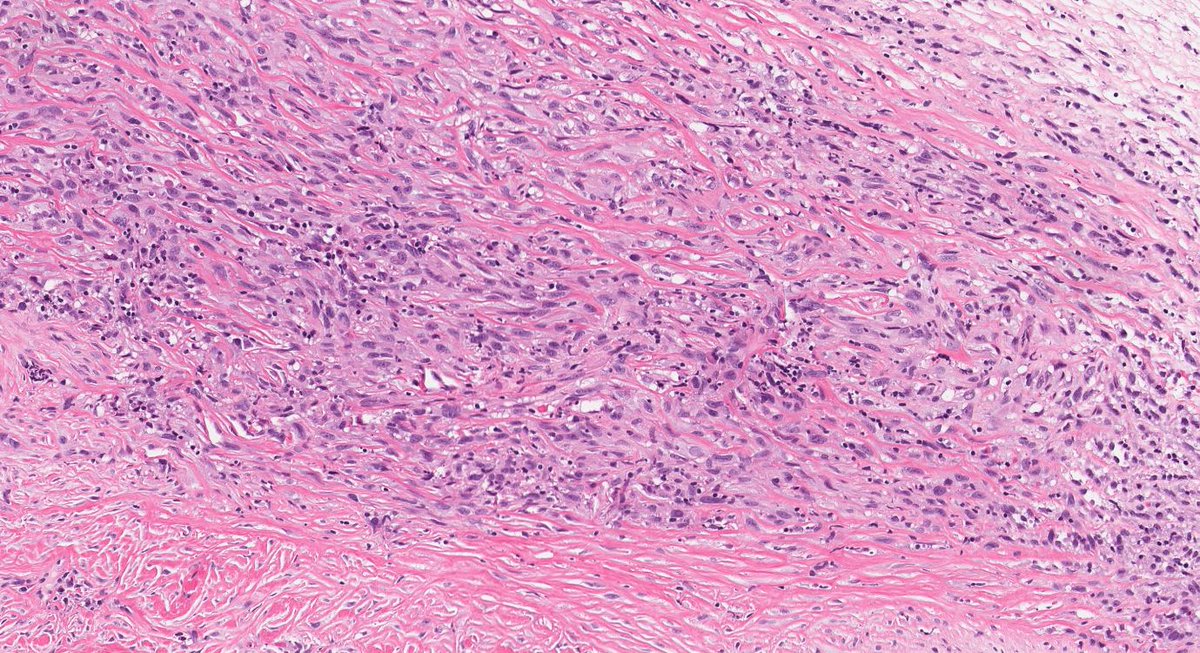 Pleural plaque with sarcomatoid mesothelioma