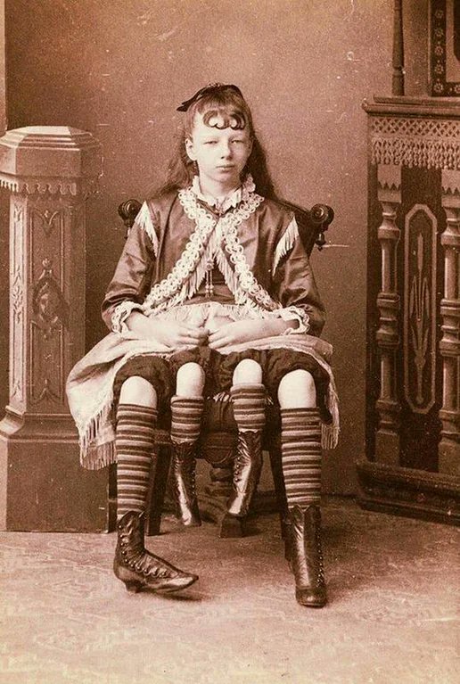 Photographed in 1880, Myrtle Corbin was born a 'dipygus', having two separately functioning pelvises and four legs. She could move all four but only walk with two. She had two functioning sets of reproductive organs and was able to successfully carry three pregnancies on the