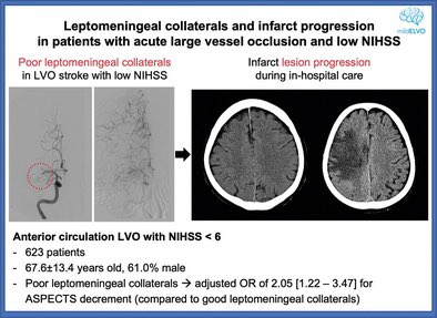 Poor Leptomeningeal Collaterals Can Predict Infarct Progression in Patients With Acute Large‐Vessel Occlusion and Low NIHSS ahajournals.org/doi/full/10.11… <a href="/StrokeAHA_ASA/">Stroke AHA/ASA</a> <a href="/WorldStrokeOrg/">World Stroke Org</a> <a href="/WorldStrokeEd/">World Stroke Academy</a> @