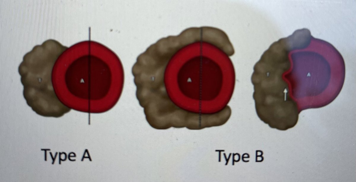 SyedAAhmad5's tweet photo. Type A versus Type B Locally Advanced Pancreas Cancer. 

@SurgJournal @SAGES_Updates @SSATNews @juliomayol @TomVargheseJr @IHPBA @AnnSurgOncol @SocSurgOnc https://t.co/uvshdEiW6I