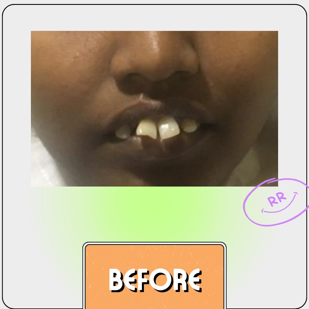 rr_dental's tweet photo. It's always a good day when you make someone smile and we are happy that this is our job

Book your appointments, link in bio

#dentalcrowns #dentalbridges #dentalclinic #vadapalani #tnagar #ashoknagar #kodambakkam #kknagar #toothdecay #toothbridge #weloveourjob #beforeandafter https://t.co/E6jsT9wV4I