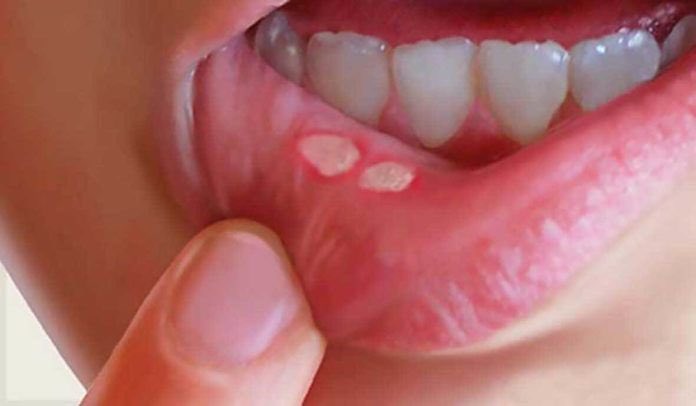 EstebanKle's tweet photo. Famosas Aftas Bucales.
📍 Suele aparecer en personas con: 
- Procesos alérgicos
- Recién infecciones virales
- Estrés, Ansiedad.
💊 Manejo recomendado: PYRALVEX, aplicar tres veces al día sobre la lesión). https://t.co/OynzoMxO1K