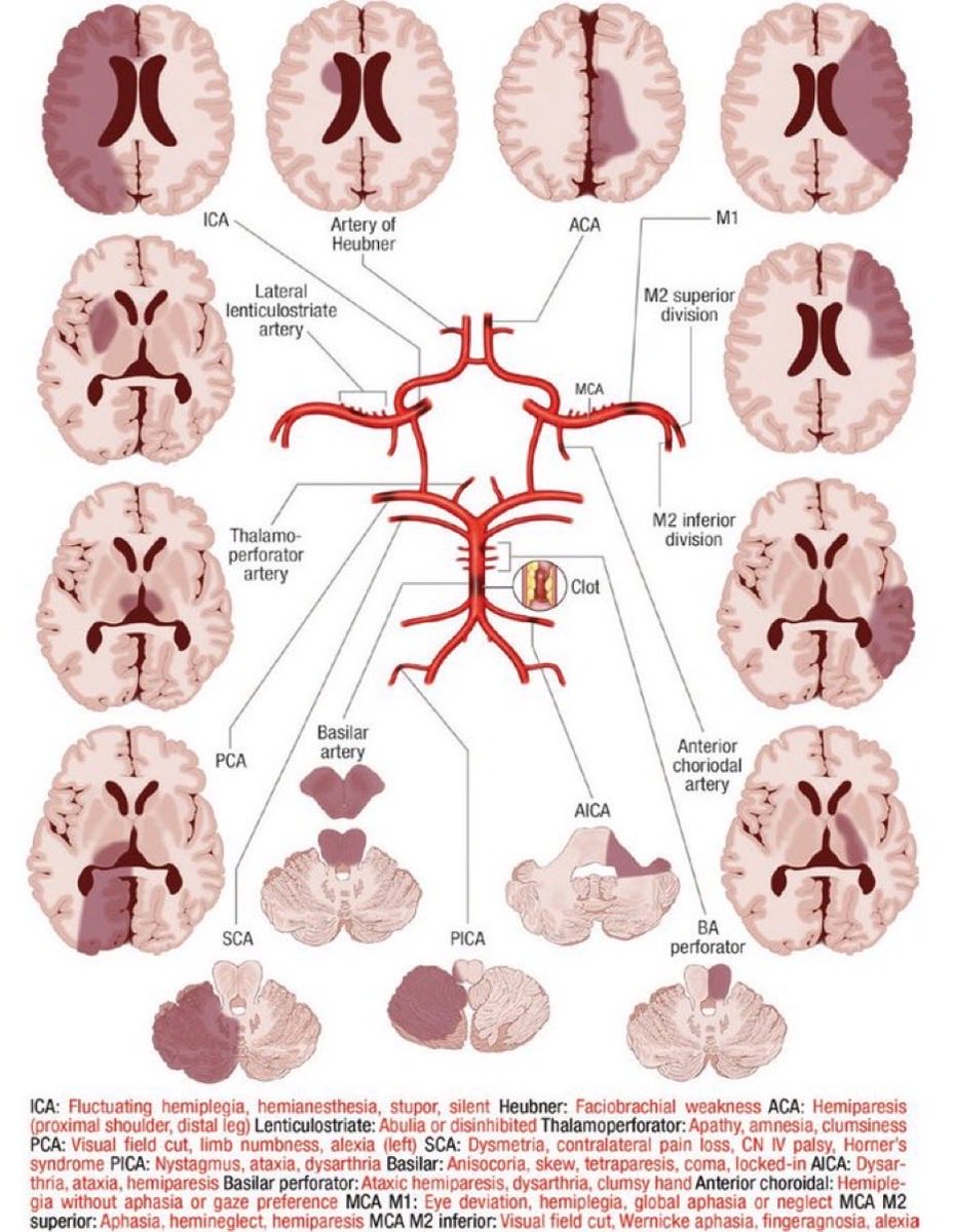 Circle of Willis vascular territories and strokes.

Source: Examining Neurocritical Patients 1st Ed by Wijdicks

#neuroscience