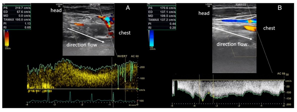 The role of jugular valve abnormalities in paroxysmal positional #vertigo #flow #innerear #brain #CCSVI 
google.com/url?q=https://…