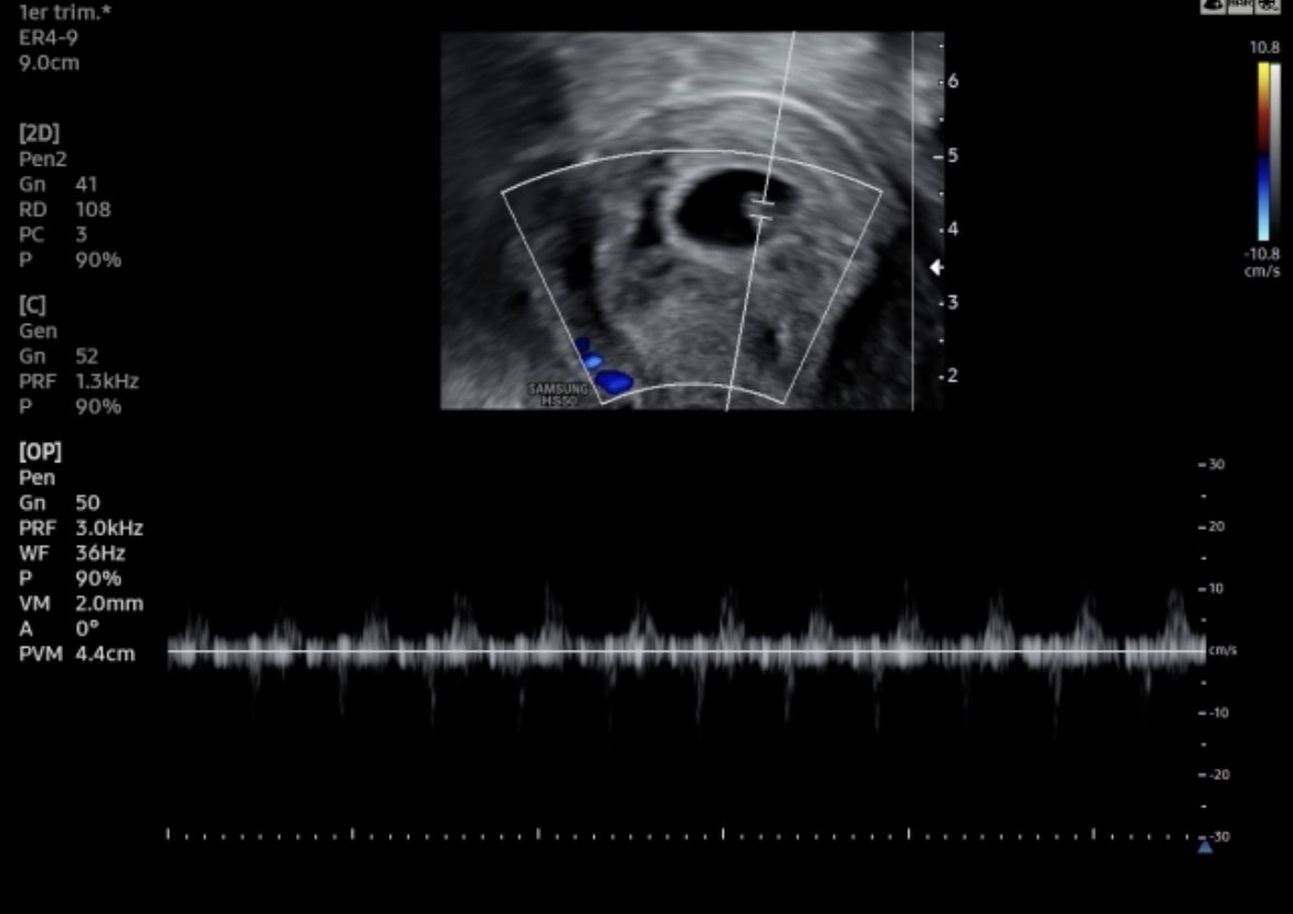 #infertilpandy hoy teníamos la eco de control. Hay embrión y hay latido. 
Es muy pequeñito aún, pero nos ha dicho que todo bien. Tenemos la eco oficial de RA el 06/06. Estamos muy felices, emocionados, contentos… en fin que os voy a contar #pasitoapasito 🎉🎊🍀🎉❤️💗🙏🏻