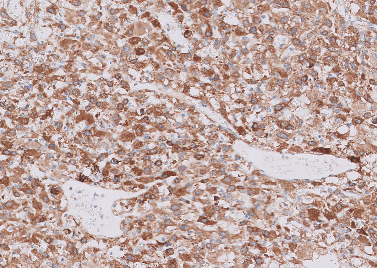 Cerebellar tumor in an adult.

Guess the IHC marker.

A neuropath classic.

#PathTwitter #Neuropath