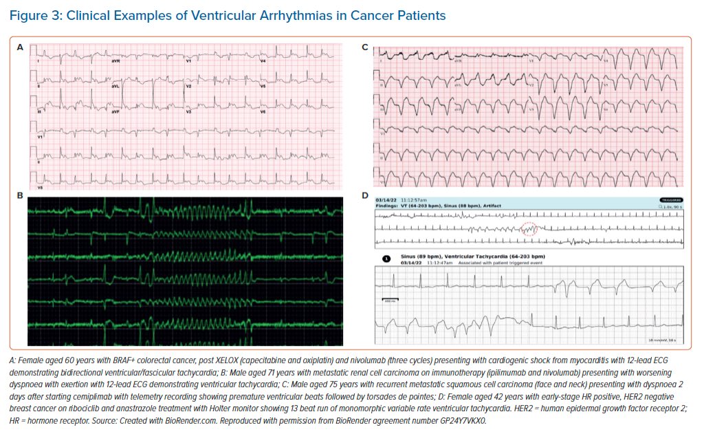 #Epeeps!

Arrhythmias can stem from cancer biology & cardiotoxicity, esp VAs

See @radcliffeCARDIO review by fmr @uclaCVfellows #bruinhearts @manyooa, now leading #cardioonc in @CCAD on mechanisms, tx & surveillance strategies…all which need more 🔎

aerjournal.com/articles/ventr…