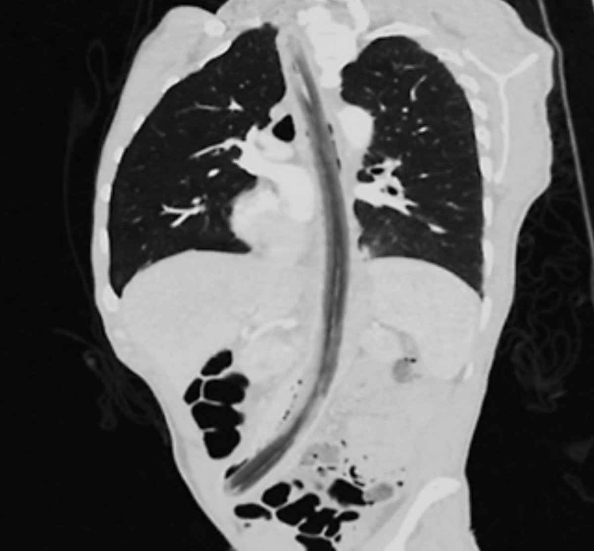 Keith Siau on Twitter "“Doctor, I swallowed a stick”. Can you spot the