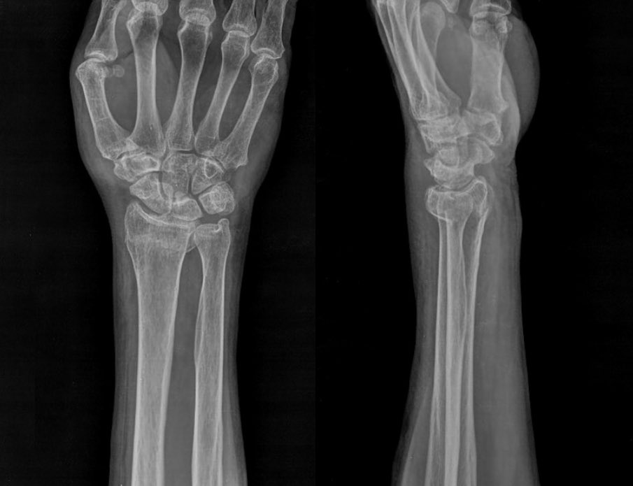 orthoEMpearls's tweet photo. FOOSH There it is! 70yo presents to the ED with wrist pain after a fall. Find out full details including the Dx and ED management here: https://t.co/bdXpeWFqVJ

#FOAMed #EmergencyMed #Ortho #SportsMed

courtesy of Ayush Goel, https://t.co/AsKCiiA6RJ, rID:41322 https://t.co/RJNnKxguxP