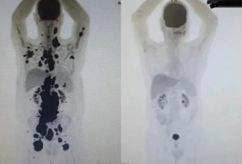 Pragmatismo_'s tweet photo. 🚨VEJA: Um mês após ser submetido a terapia celular em estudo no SUS, paciente que lutava contra o câncer há 13 anos e que estava prestes a receber cuidados paliativos tem remissão total. Técnica é considerada revolucionária no tratamento contra a doença https://t.co/bBHJWq6J1G