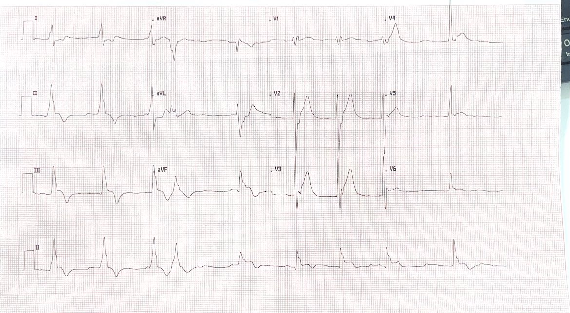 lucasojesilva12's tweet photo. What are the diagnoses that come to your mind with this EKG? Assuming prior EKG is normal.
#EM #EKG #ECGcases #FOAM #FOAMed https://t.co/XyMRAQ3s5u