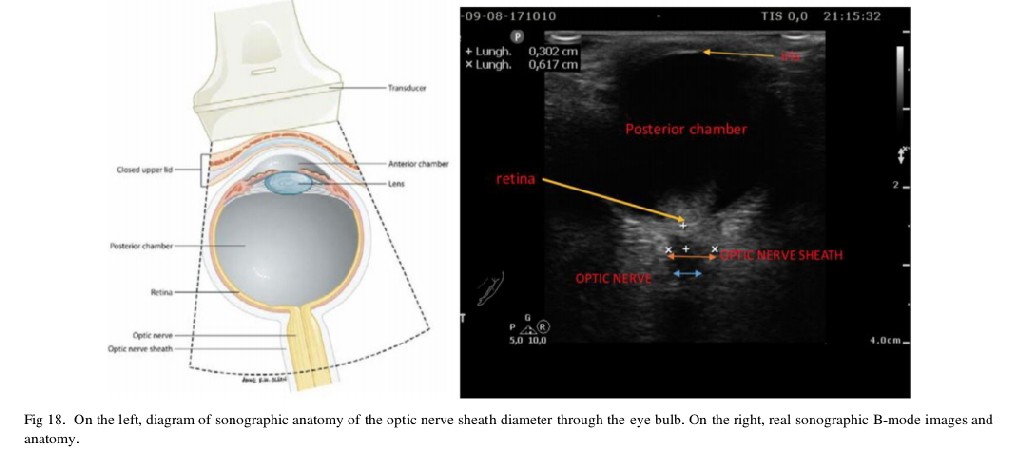 🧠Transcranial Doppler and Optic Nerve  Sonography

Frank A. Rasulo*,y,1, Rita Bertuettiy

drive.google.com/file/d/1N8vEx2…