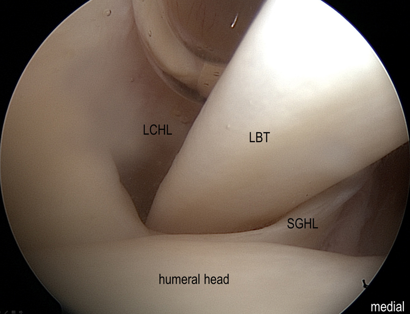 samrad77's tweet photo. Rotator interval: Schematic, anatomical, arthroscopic and ultrasound correlation! 

Reference: 
Ultrasound Int Open. 2017 Jun; 3(3): E107–E116.
doi: 10.1055/s-0043-110473

Full text pdf: 
https://t.co/ozUZwqF0Ej https://t.co/IdZMjRPppS