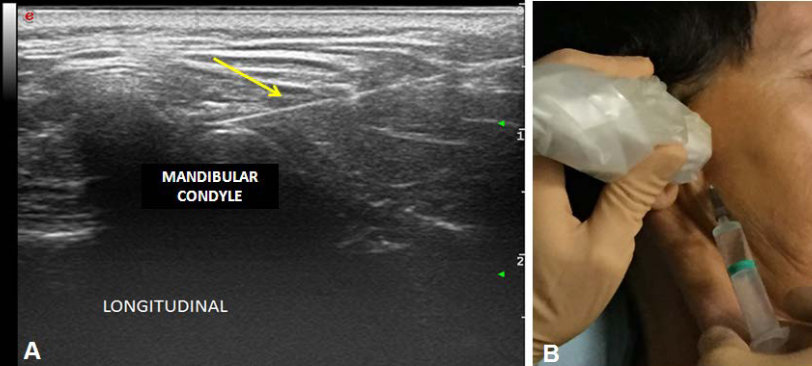 ultrasound guidance for TMJ arthrocentesis
and intra-articular injection

FREE PDF

dmp.umw.edu.pl/pdf/2022/59/4/…

and 

rmes.univ-nantes.fr/medias/fichier…
