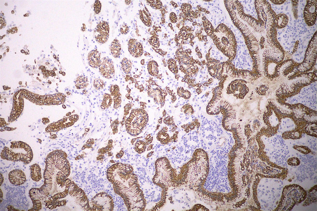 Starting the day with the subtlety of these gastric adenocarcinoma with poorly cohesive cells in a young man. #gipath #pathology