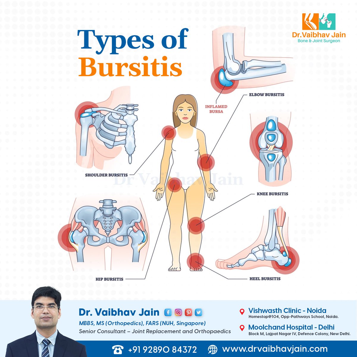 🔍✨ Types of Bursitis 😯🔬 Discover the different types of this common condition and how it affects your body. 🩹

#TypesOfBursitis #JointHealth #KnowYourBody #StayInformed #EmpowerYourself #HealthAwareness #DrVaibhavJain #Delhi #Noida #noidadiaries #delhidiaries