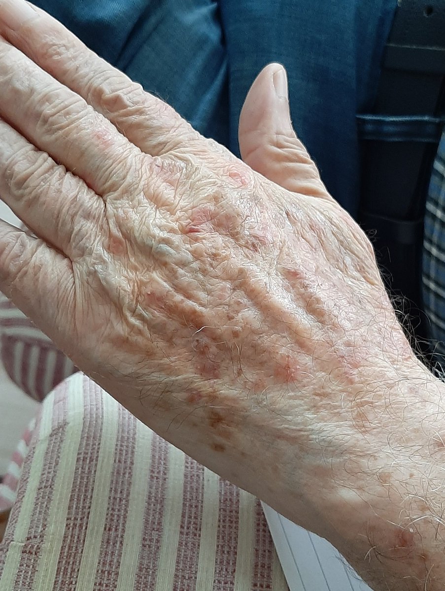 Arkadaşlar, bugün sanırım 7.gün. Ya 3 kez, ya 4 kez 
"Gül Sirke Anası" sürdükten sonra, babamın eli.
Lütfen tüm gül üreticilerine duyurun, sirke yapsınlar,sirke anası üretsinler.Zemzem koymayı unutmasınlar. Hepimiz evlerde de yapalım.Umarım gerek kalmaz ama yaralardan korkuyorum.