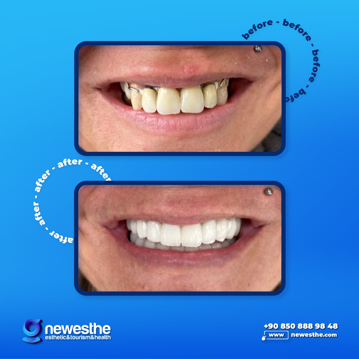We redesigned the smile of our esteemed patient by applying 12 implants and emax zirconium coating to all teeth.

You can contact us for more information.

☎️ Whatsapp International :
+90 850 888 98 58
🌐 : newesthe.com

#laminateveneer #gumtreatment